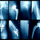 X-ray Artificial joints
